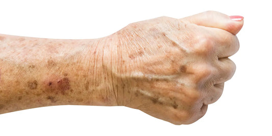 Faust einer älteren Person mit Altersflecken auf Handrücken und Unterarm